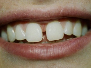 فاصله بين دندانها
