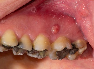 واكنشي از پالپ دندان (توده اي از رگ و عصب درون مركز دندان)