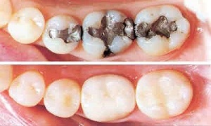 مراقبتهای پس از پرکردن دندان