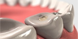 مراقبتهای پس از پرکردن دندان